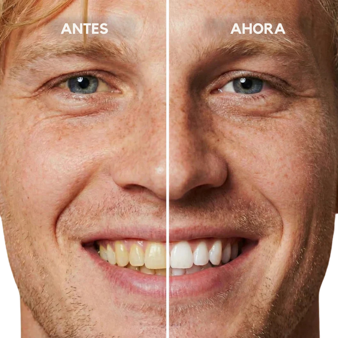 Blanqueador Dental Cosmético – Sonrisa Blanca en Segundos